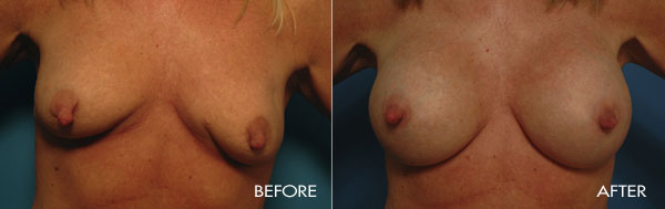 Revision Breast Procedures