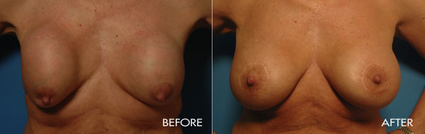 Revision Breast Procedures
