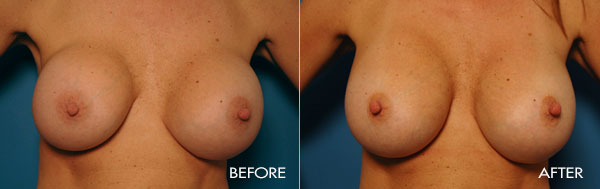 Revision Breast Procedures