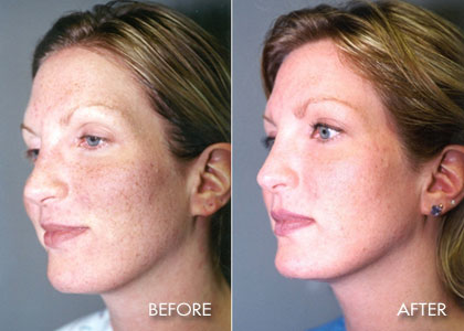 50 Micron Micro Laser Peel