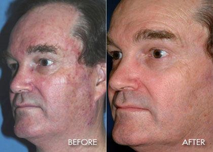Full Micro Laser Peel