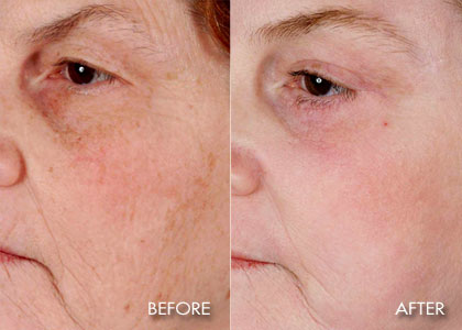 40 Micron Micro Laser Peel