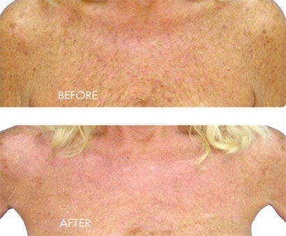 before and after image of bbl treatment on chest