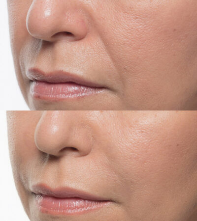 before and after results of bellafill used on nasolabial folds