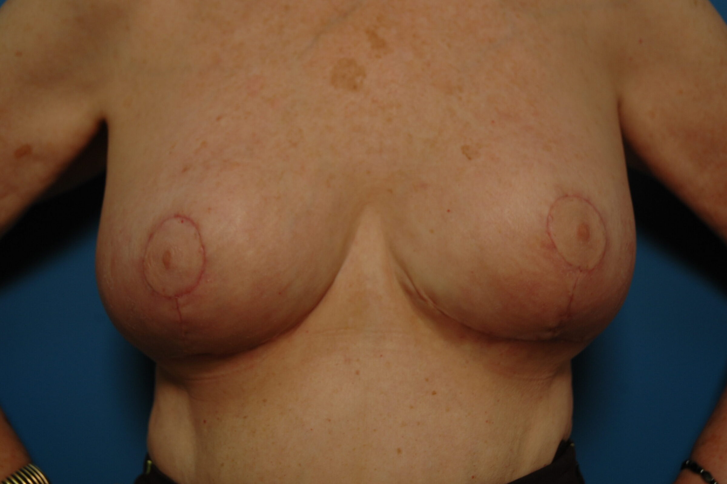 Breast Reduction - After