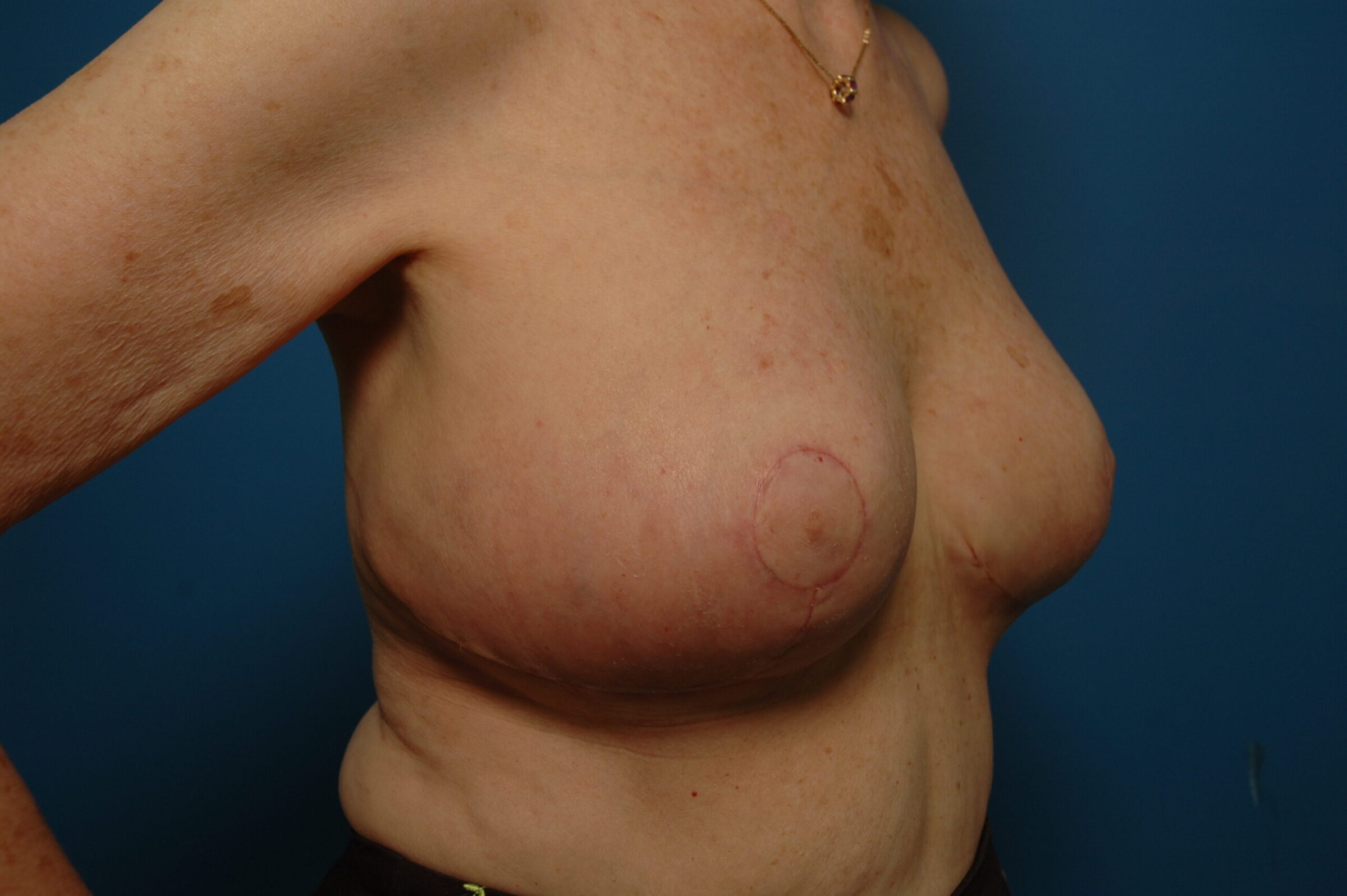 Breast Reduction - After