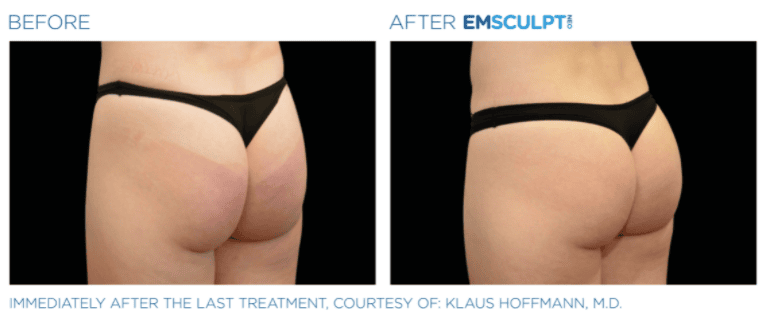 Before & after Emscuplt Neo Treatments on buttocks
