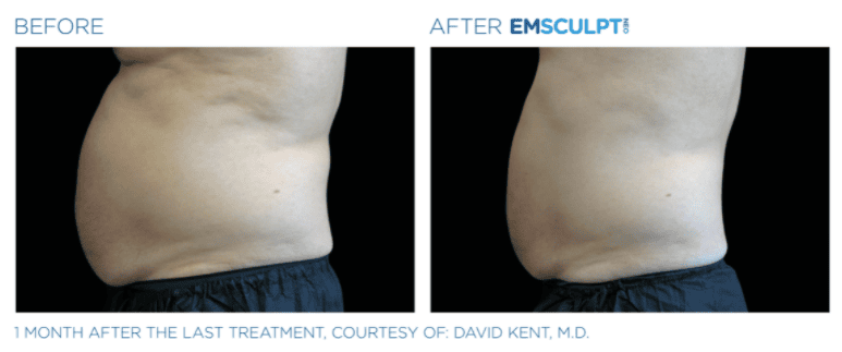 Before & after Emscuplt Neo Treatments on abdomen