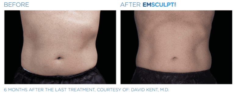 Before & after Emscuplt Neo Treatments on abdomen