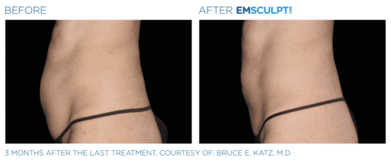 Before & after Emscuplt Neo Treatments on abdomen