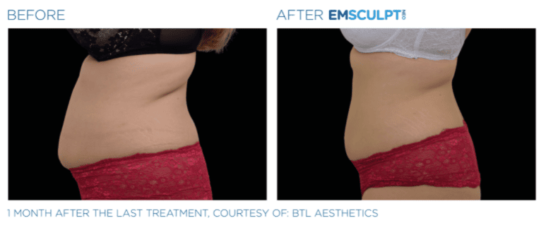 Before & after Emscuplt Neo Treatments on abdomen