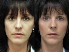 Sculptra--1 Treatment 2 Vials