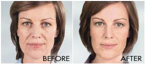 Sculptra--2 Treatment 2 Vials