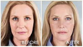 Sculptra--1 Treatment 2 Vials