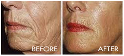 Sculptra--4 Treatments 2 Vials per Treatment