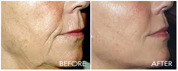 Sculptra--4 Treatments 1.5 Vials per Treatment