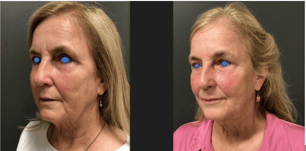 B&A of FaceTite, AccuTite, and Morpheus8