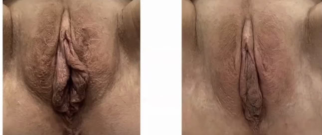 Before & after results of out labial treatment using Aviva