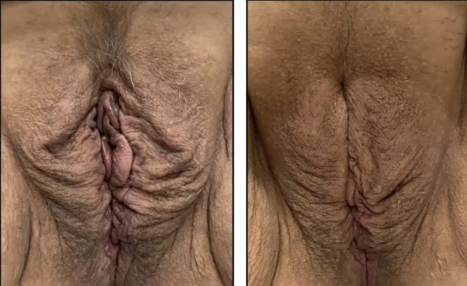 Before & after results of out labial treatment using Aviva