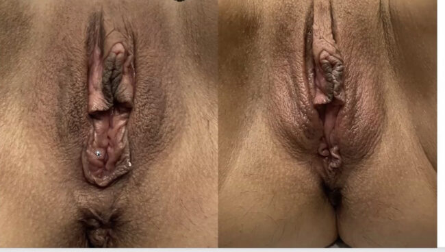 Before & after results of out labial treatment using Aviva