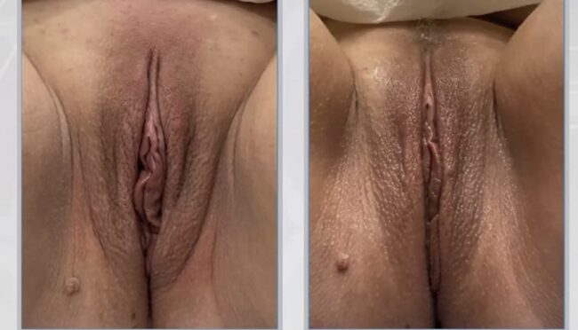 Before & after results of out labial treatment using Aviva