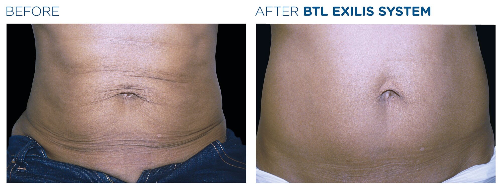 EXILIS Skin Tightening - abdomen
