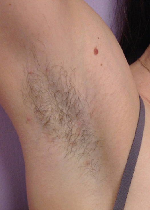 Before laser hair removal