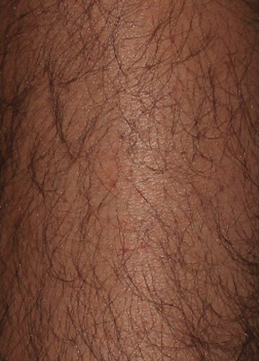 Before laser hair removal