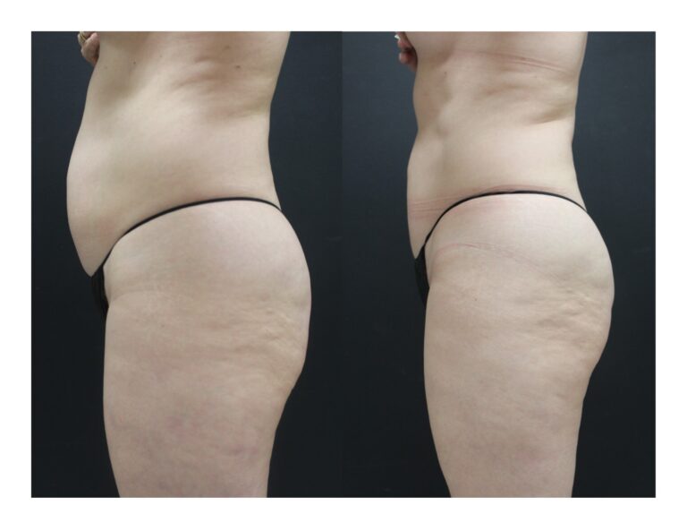 Womans torso and thighs before and after receiving Ultrashape Power Treatment