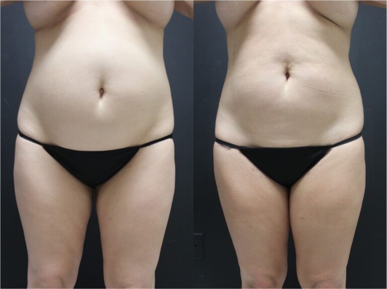 Womans torso and thighs before and after receiving Ultrashape Power Treatment