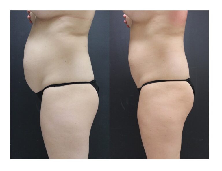 Womans torso and thighs before and after receiving Ultrashape Power Treatment