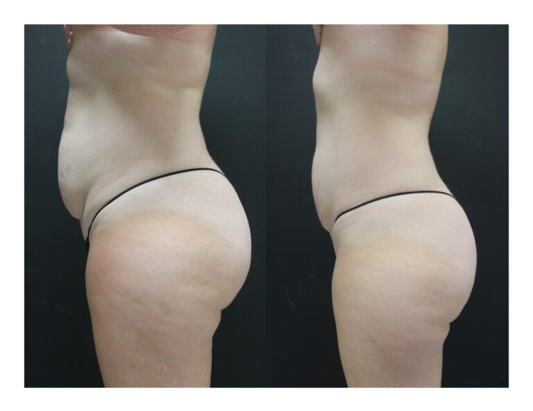 Womans torso and thighs before and after receiving Ultrashape Power Treatment