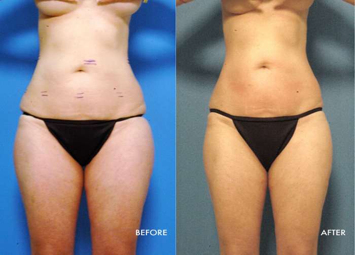 Womans torso before and after Vaser Shape procedure