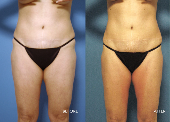 Womans torso before and after Vaser Shape procedure