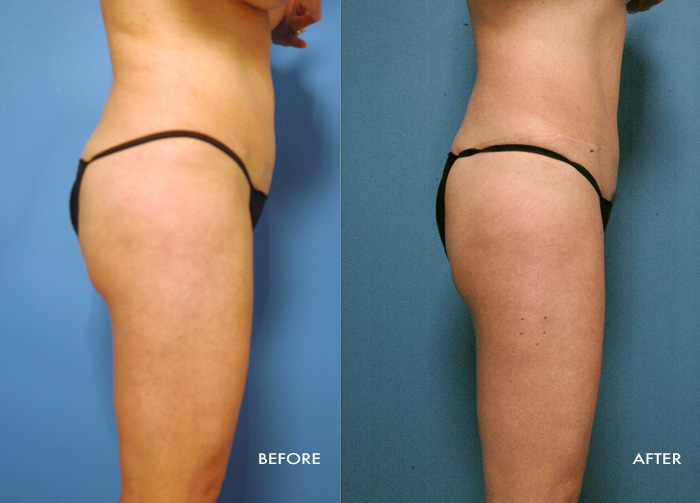 Womans torso before and after Vaser Shape procedure
