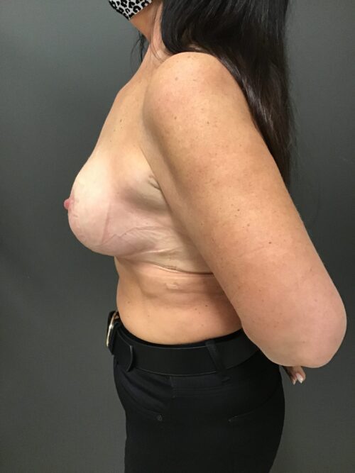 Post breast reduction results