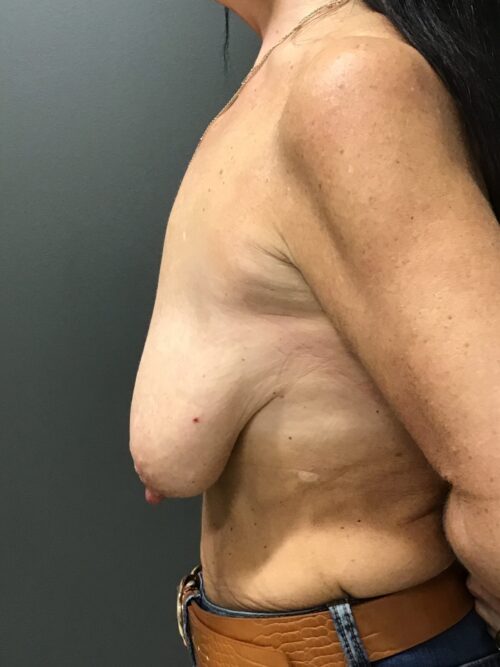 Large sagging breasts