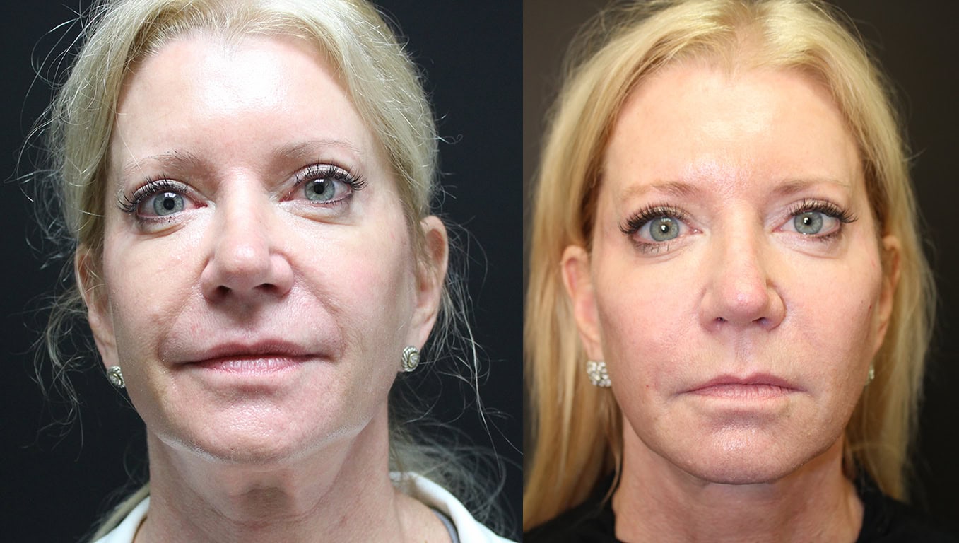 Prior to Profound Treatment and after 3 months