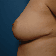 Post breast reduction results