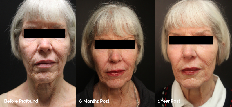 Pre Profound, and at 6 months post single Profound Treatment