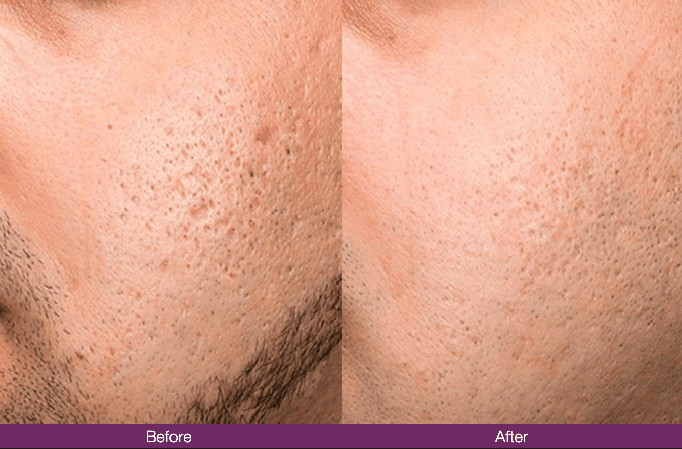 Before Exceed After Exceed Treatment face