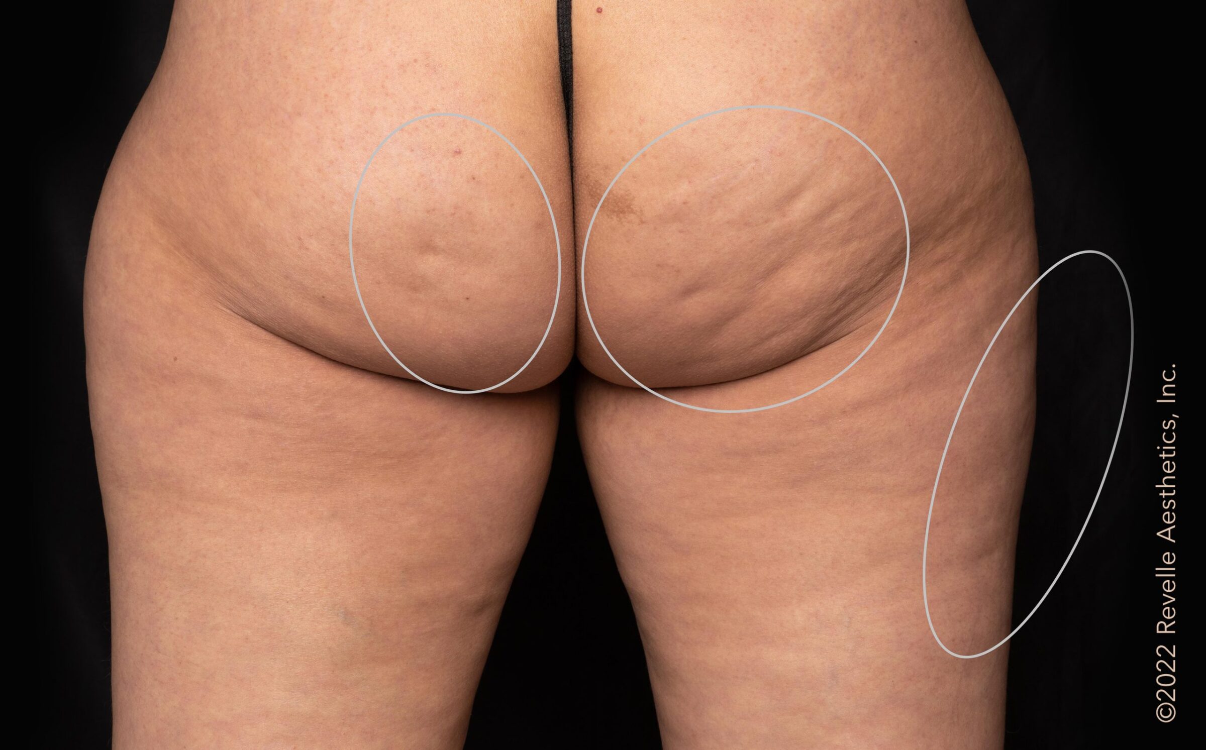 Before aveli cellulite treatment
