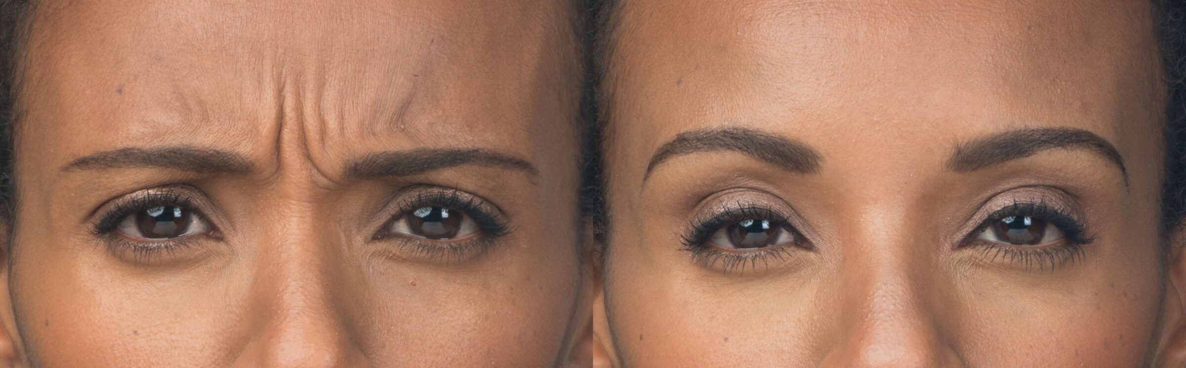 woman frowning before and after botox
