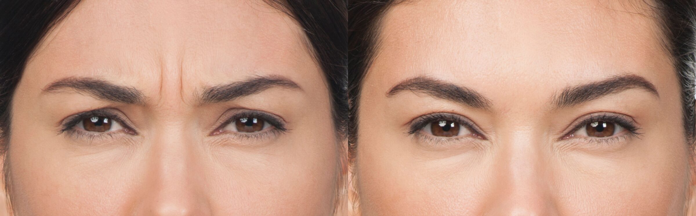woman frowning before and after botox
