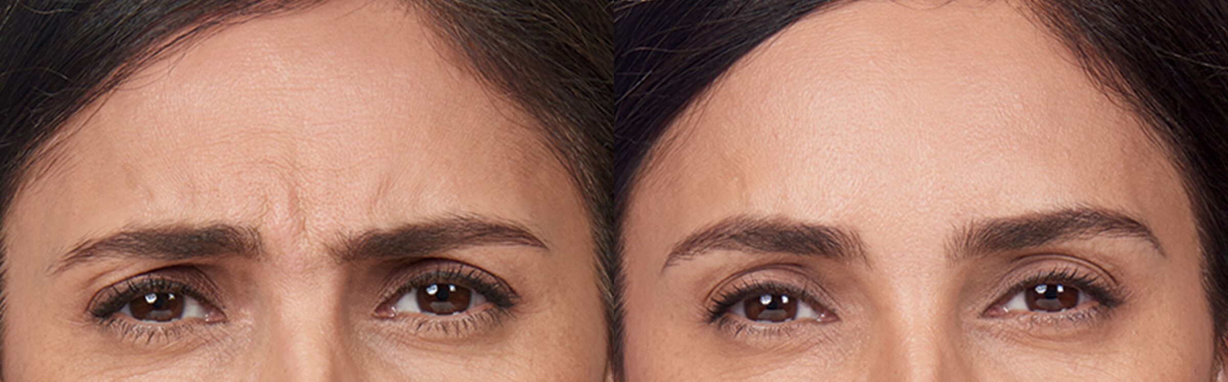 woman frowning before and after botox