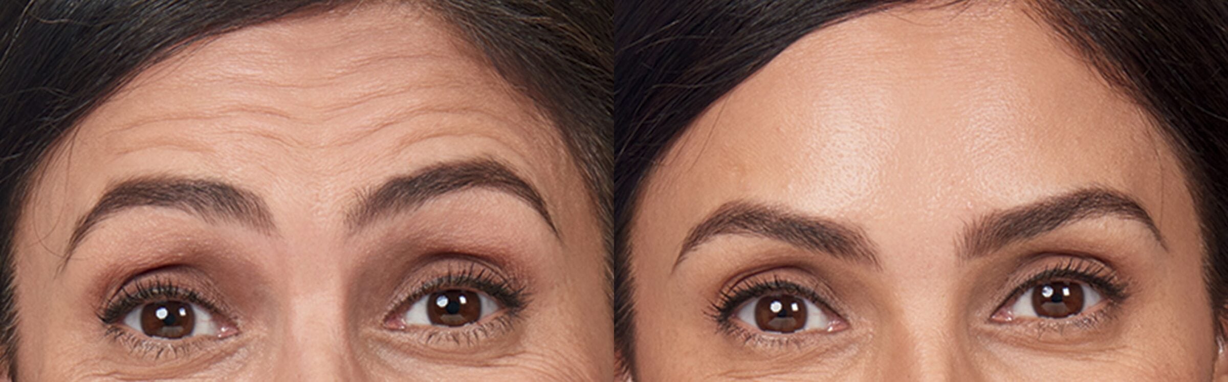 woman frowning before and after botox