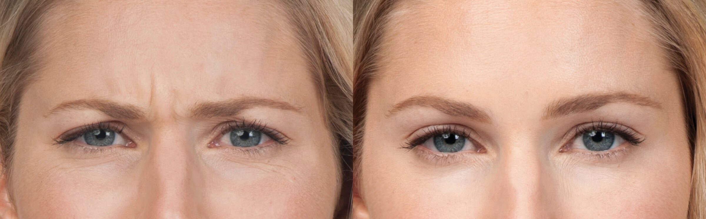 white woman frowning before and after botox