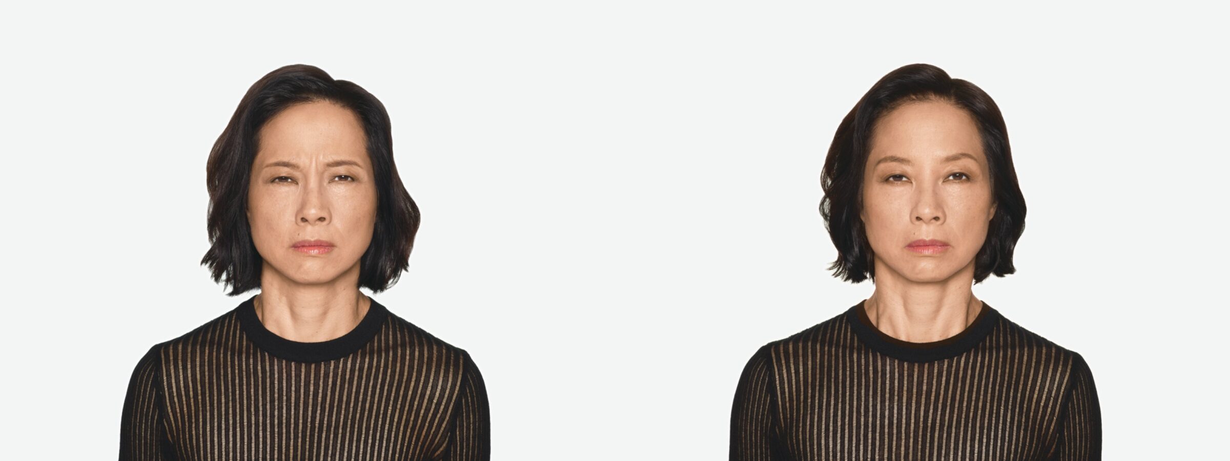before & after facial result of daxxify