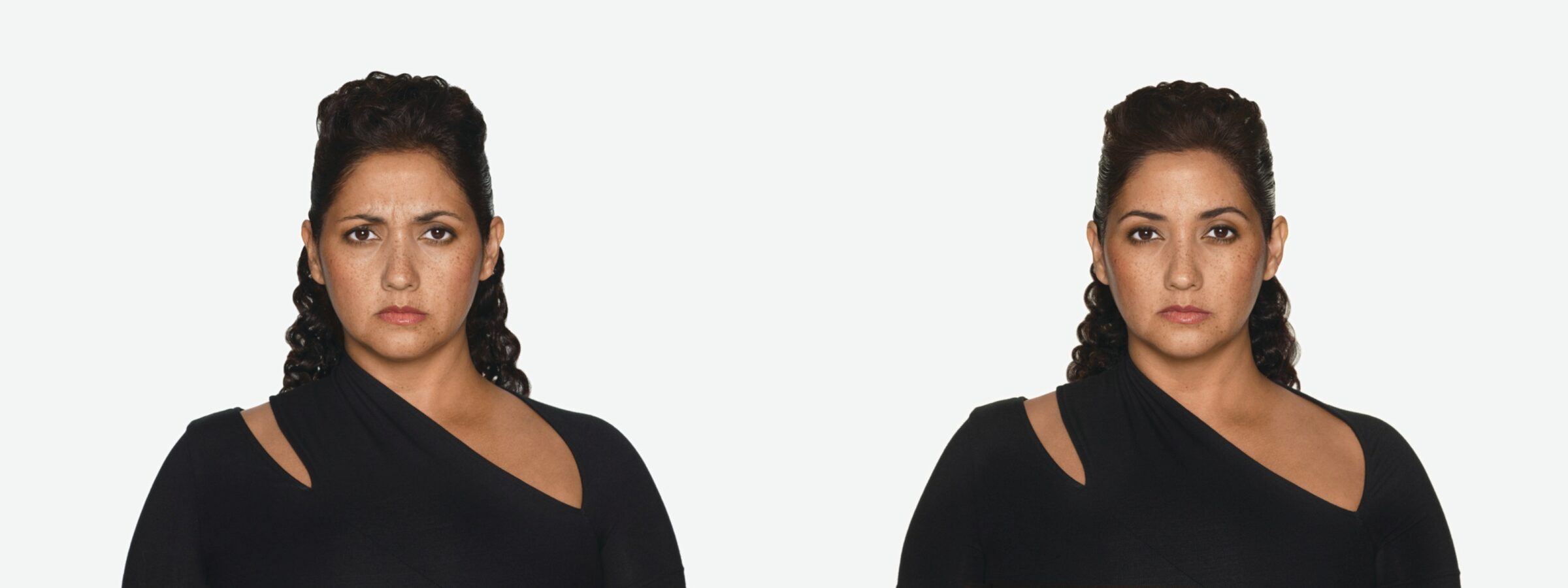 before & after facial result of daxxify