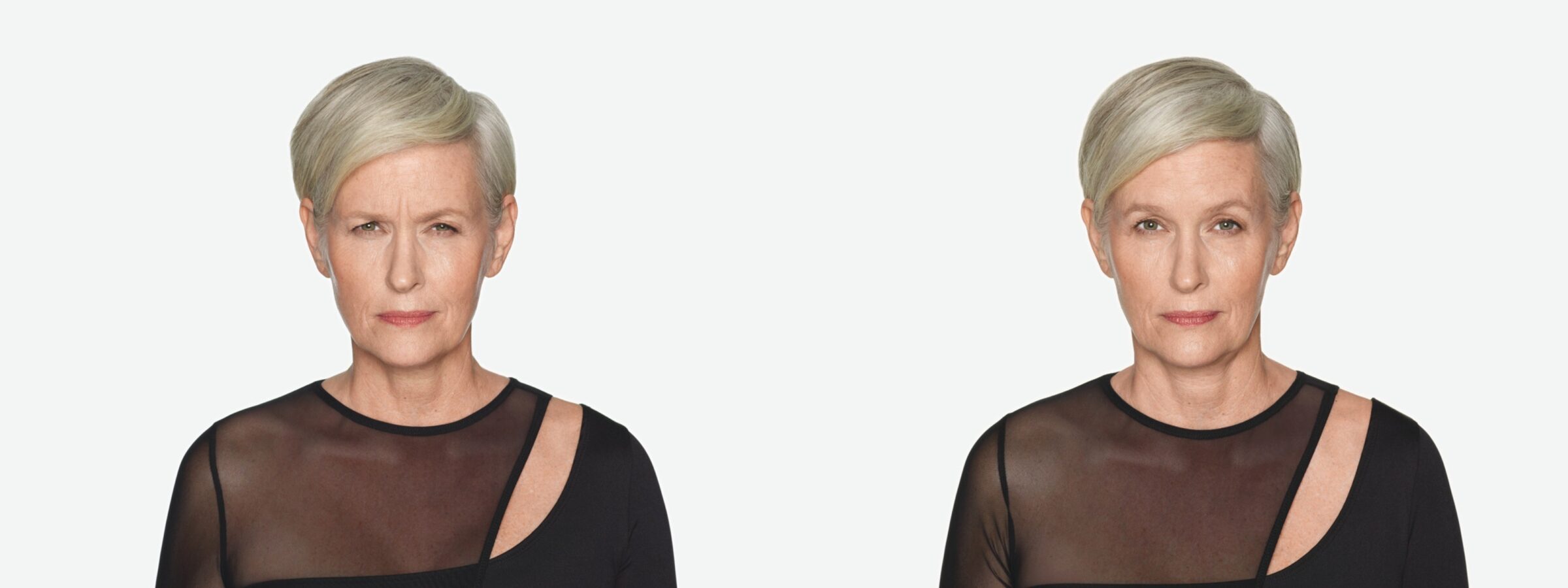 before & after facial result of daxxify